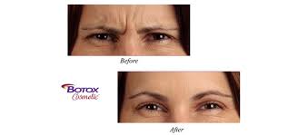 Botox, facial rejuvenation (before & after)