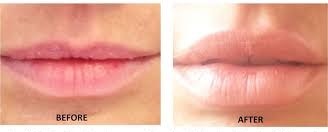 Botox, lip enhancement (before & after)