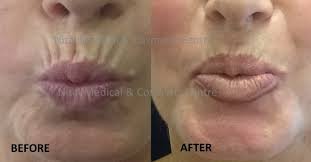 Botox, smoker's lips (before & after)